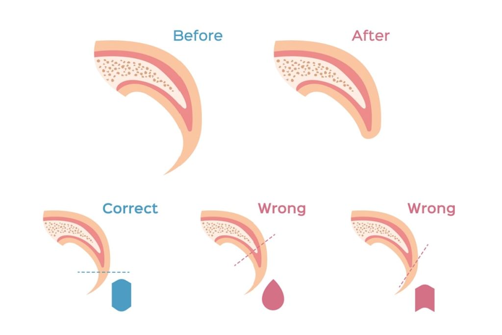 schema taglio unghie