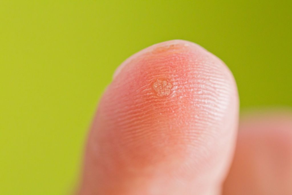 verrue sur doigt