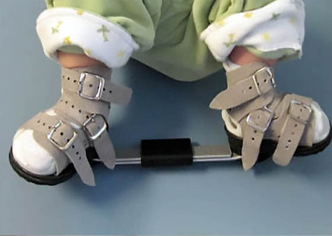 Four Tips to Get You Through the Clubfoot Brace Years