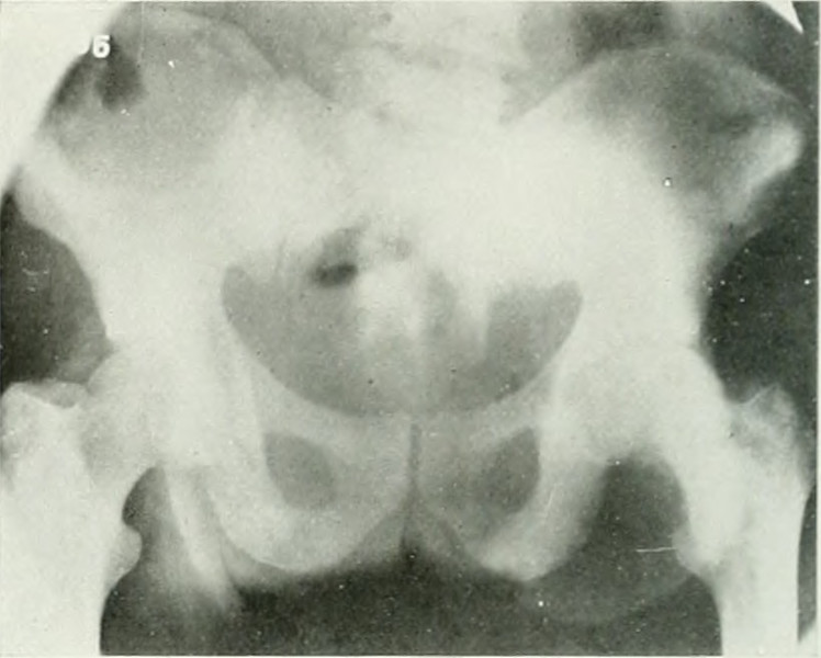 An X-ray of the pelvis in a patient with prostate cancer. Source: University of Toronto.