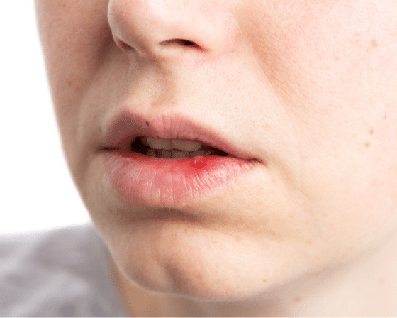 Mouth Ulcers: Their Symptoms, Causes, and Treatment