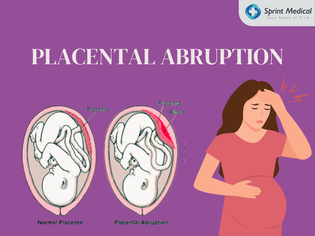 Placental Abruption