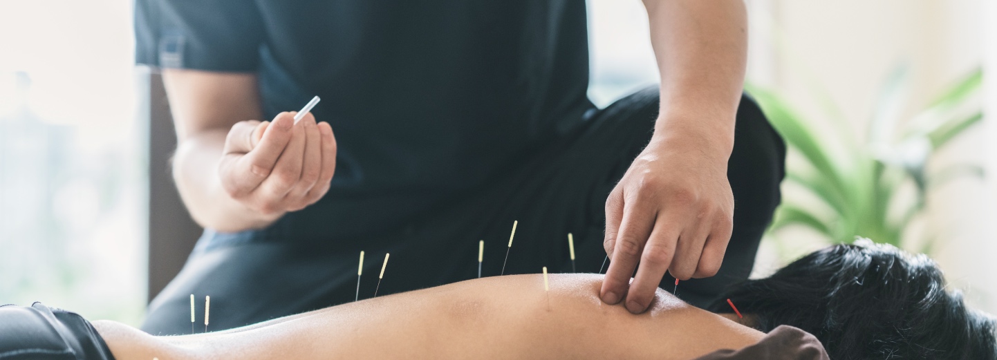 [Picture] acupuncture-full