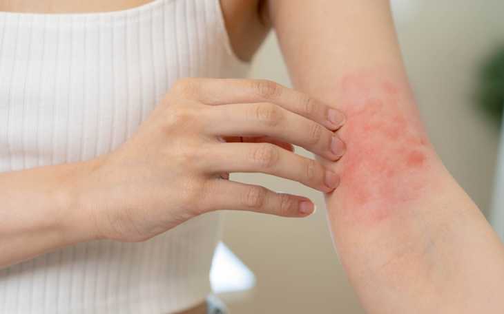 Arm Rash