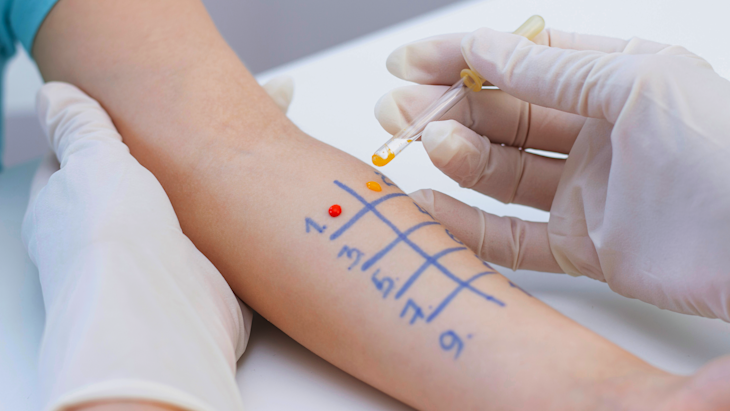 HS-Neurodermitis-Ernährung-Allergietest-
