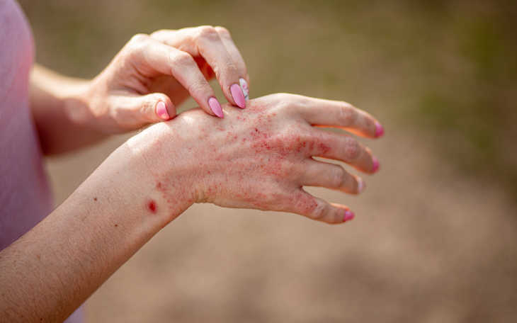 Hands allergy 