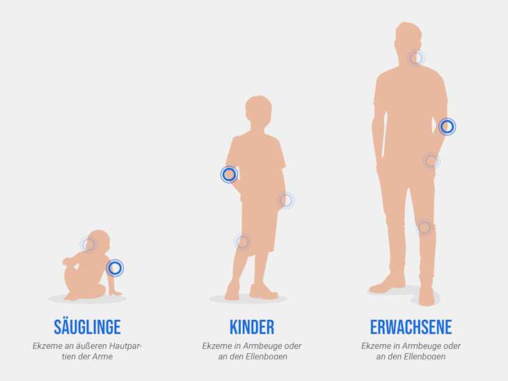 Infografik, die mit Neurodermitis betroffene Hautpartien nach Alter aufzeigt