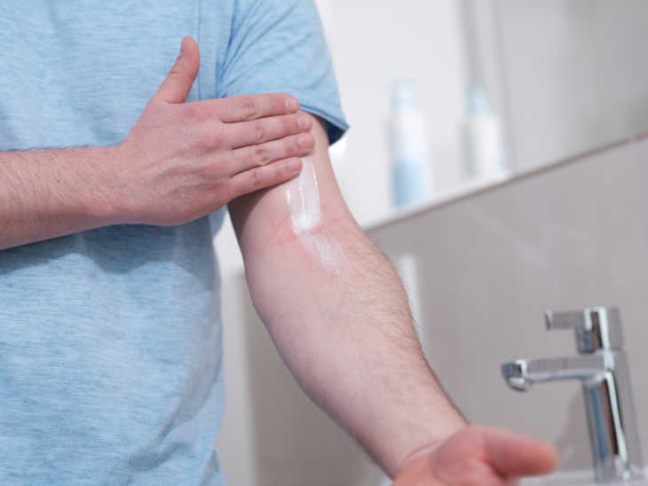 Mann cremt Neurodermitis am Arm ein