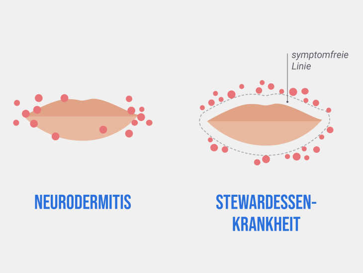 Vergleich Neurodermitis-Mund und Stewardessenkrankheit