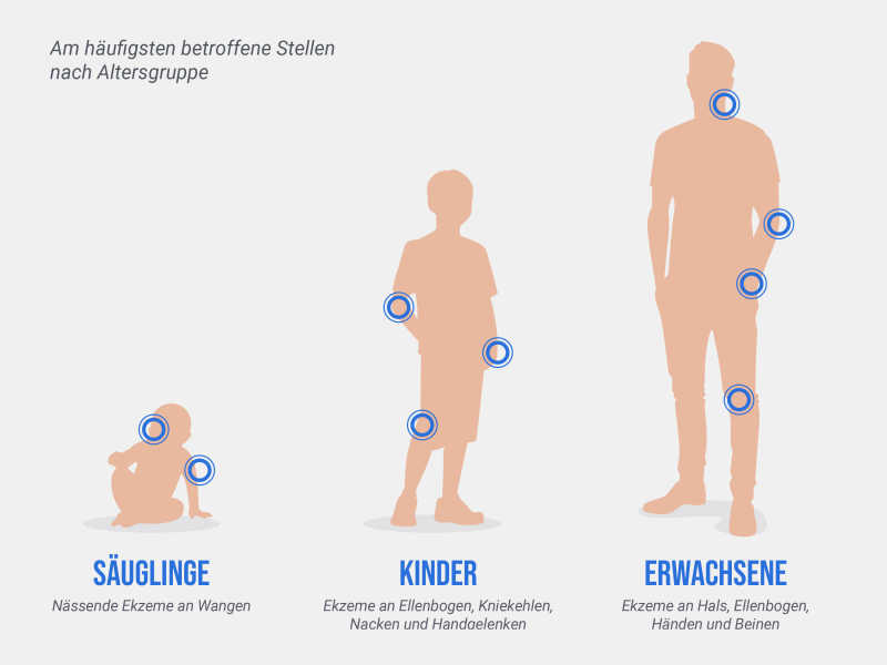 Infografik, die mit Neurodermitis betroffene Hautpartien nach Alter aufzeigt