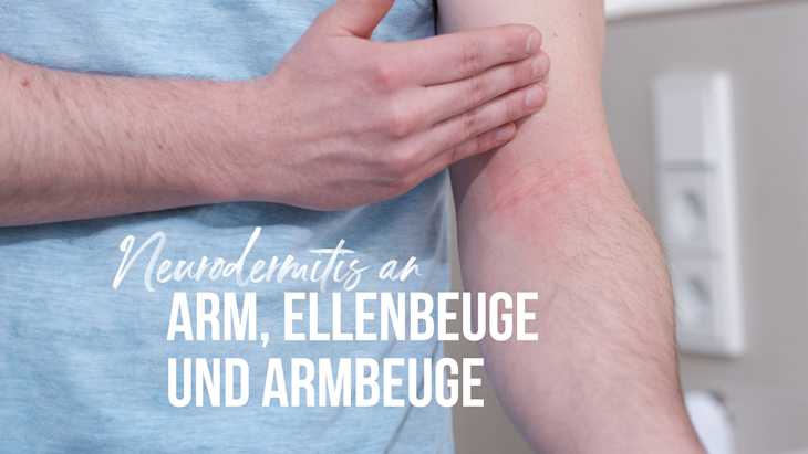 Arm von einem Mann mit Neurodermitis