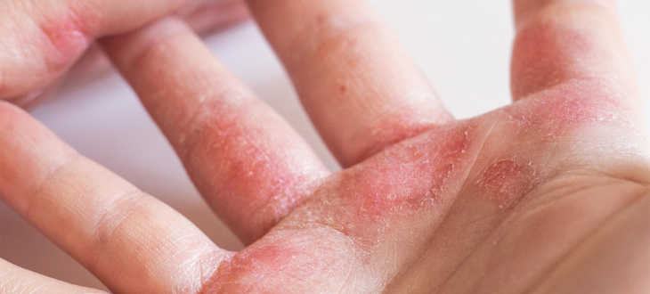 Bild von Hand bzw. Fingern mit Neurodermitis