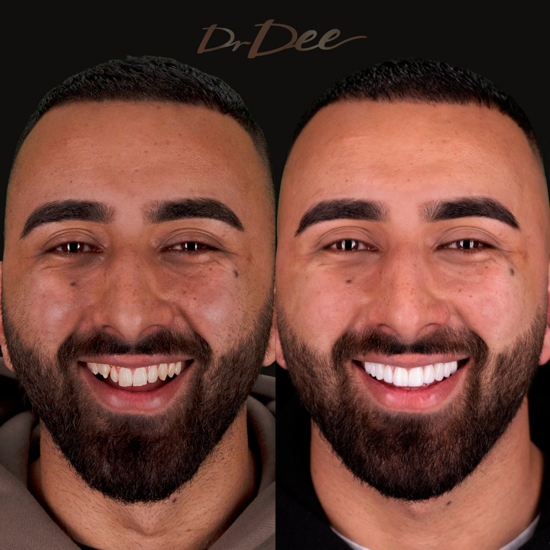 Ibrahim Akbar before and after porcelain veneers front face view.