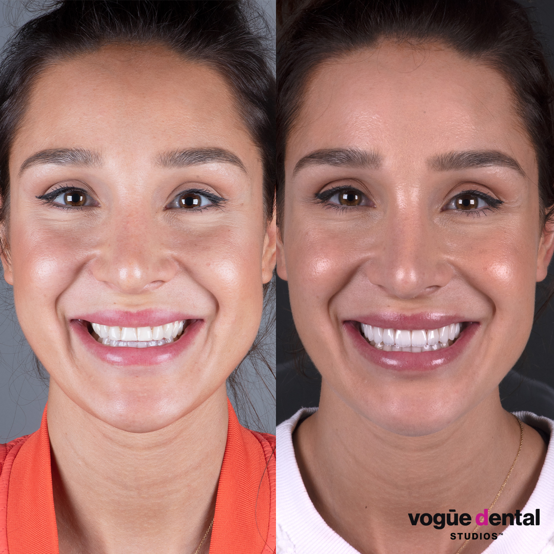 Kayla Itsines before and after porcelain veneer smile makeover front face view.