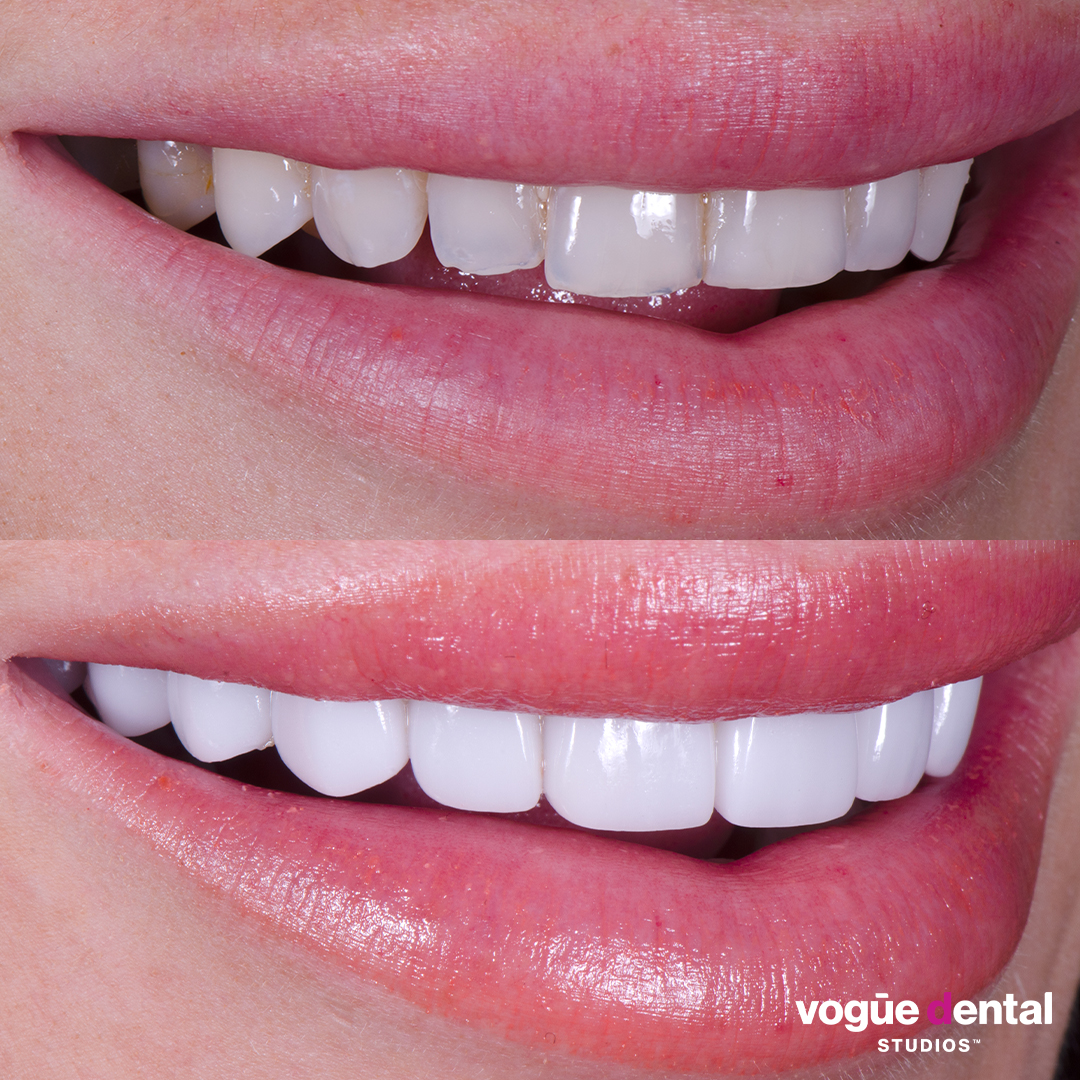 Before and after porcelain veneers smile makeover at Vogue Dental Studios - left teeth view Tash Herz.
