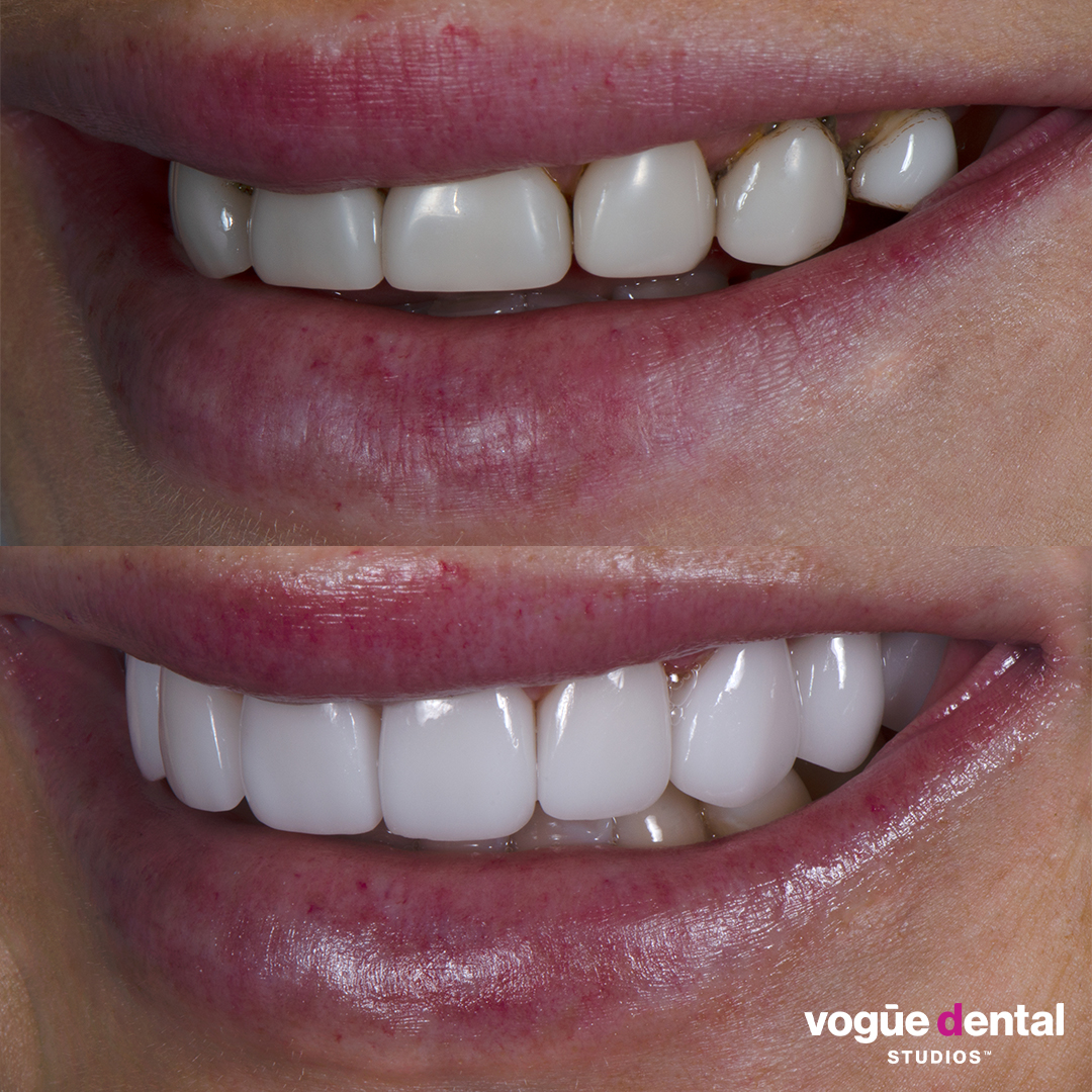 Before and after porcelain veneers smile makeover at Vogue Dental Studios - left teeth view Ines.