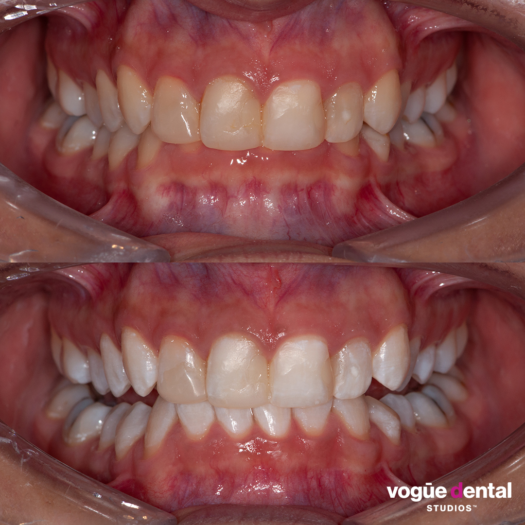 Before and after in-chair teeth whitening at Vogue Dental Studios - front retracted view Gentleman 2.