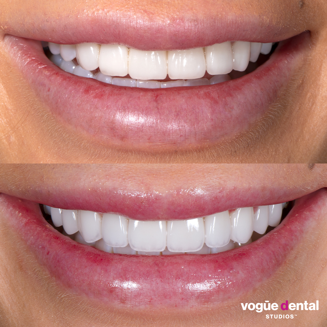 Before and after porcelain veneers smile makeover at Vogue Dental Studios - front teeth view Elise