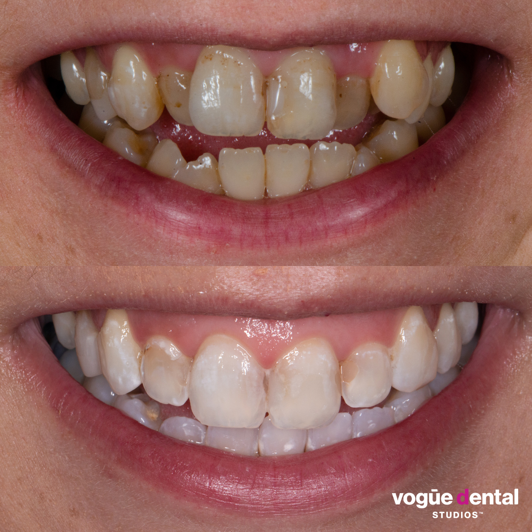 Before and after take home whitening and in chair whitening at Vogue Dental Studios - front teeth view Ash.