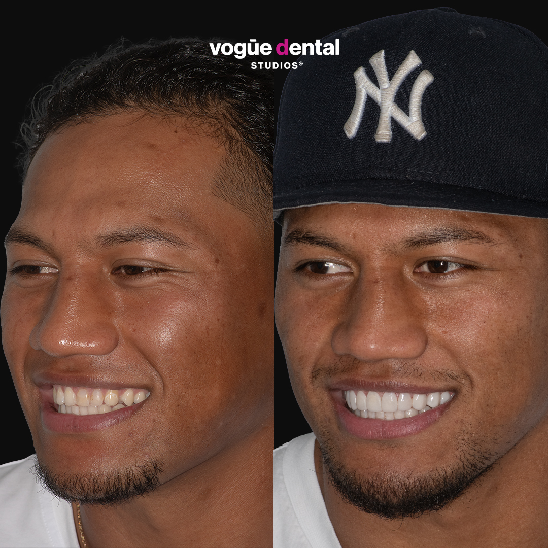 Sitili Tupouniua before and after porcelain veneers Vogue Dental Studios - full face left