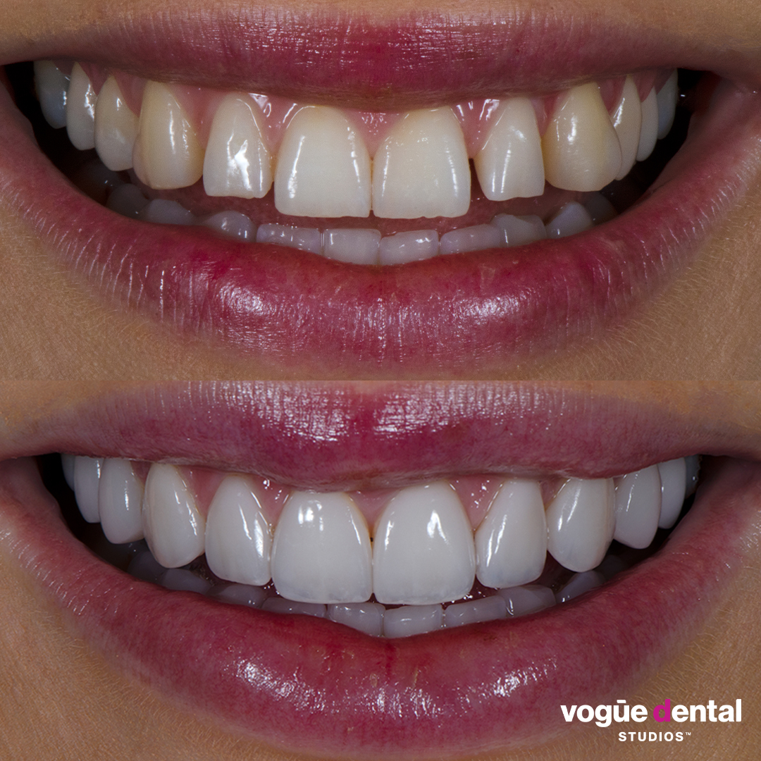 Before and after square teeth with porcelain veneers at Vogue Dental Studios - front teeth view Renee.