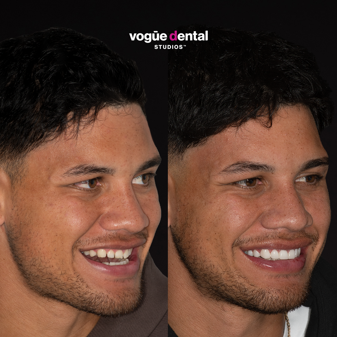 Before and after gappy teeth with porcelain veneers at Vogue Dental Studios - right face view Jaxson