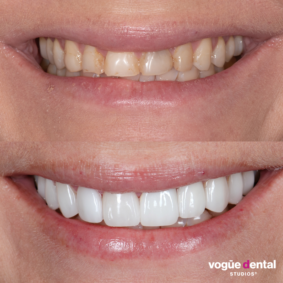 Before and after small teeth with porcelain veneers at Vogue Dental Studios - front teeth view Laura.