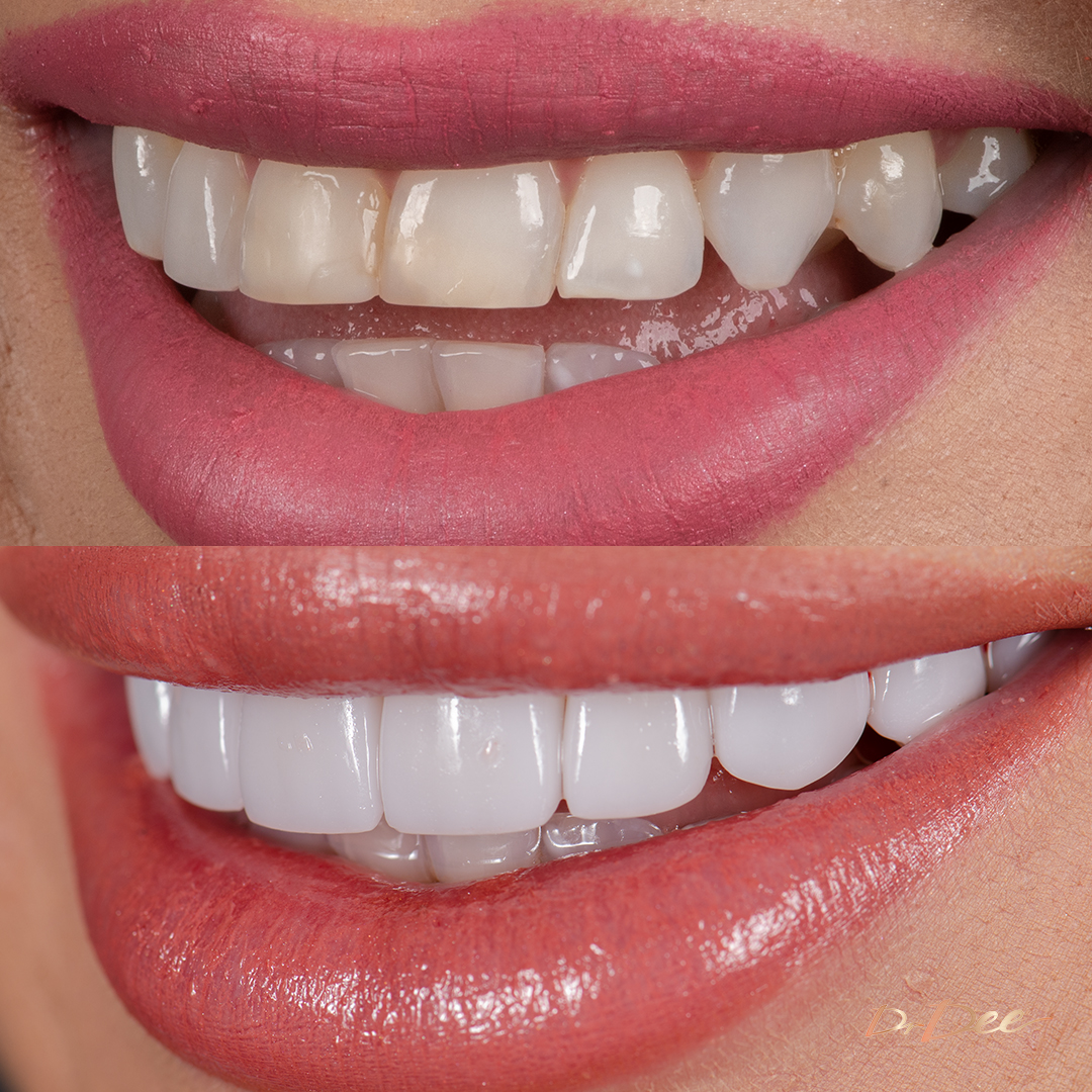 Before and after porcelain veneers at Vogue Dental Studios - left view Jessica