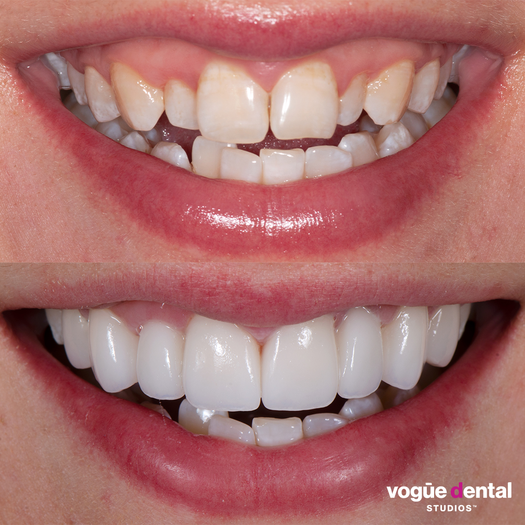 Before and after crooked teeth with porcelain veneers at Vogue Dental Studios - front teeth view Brieanna.