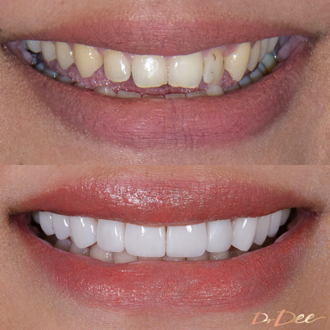 Before and after small teeth with porcelain veneers at Vogue Dental Studios - front teeth view Elizabeth.