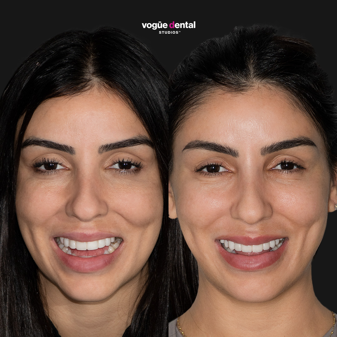 Carolina Santos revision veneers custom smile design Vogue Dental Studios - full face front