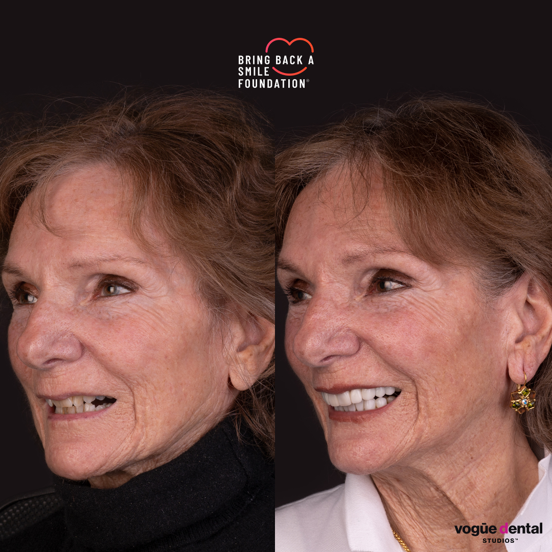Anna, a cancer patient, before and after her smile makeover with porcelain veneers - left view