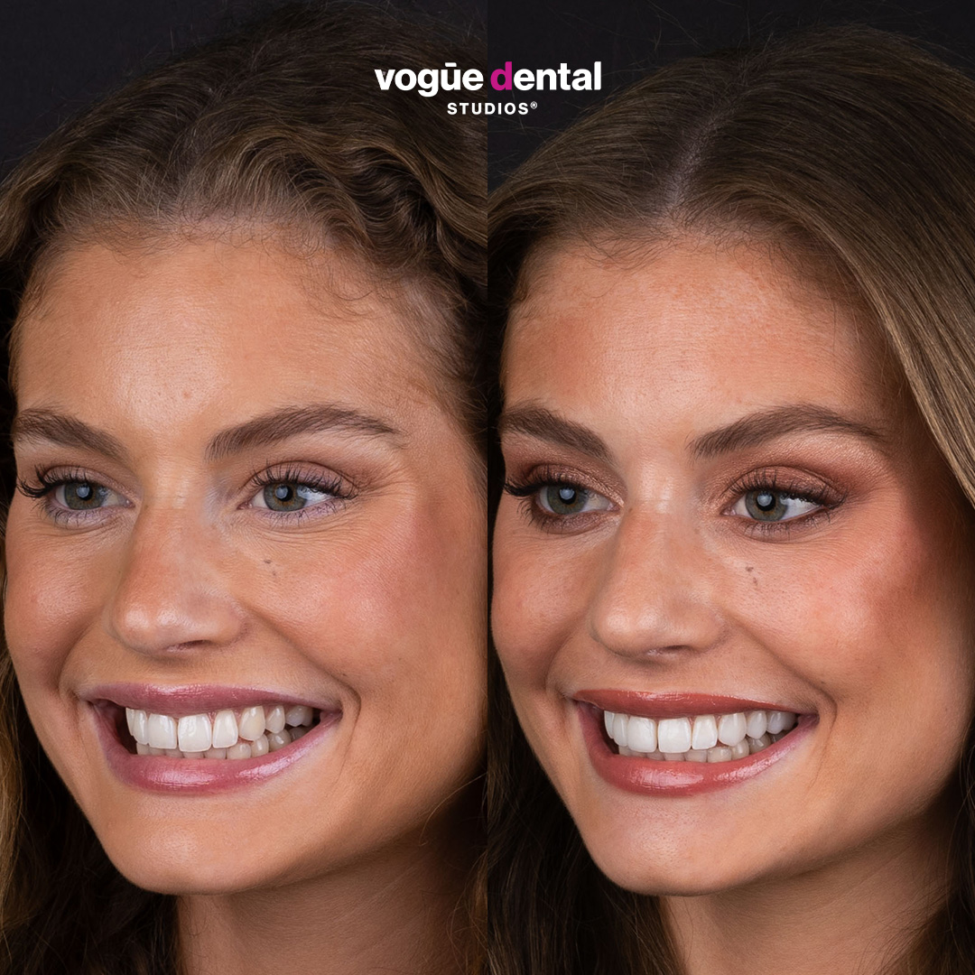 Moraya Wilson before and after porcelain veneers preserve gap in smile - left view