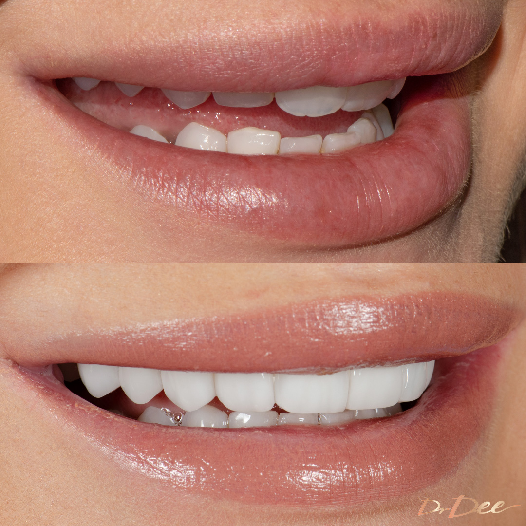 Melbourne Chippy Chick Stefanie porcelain veneers for narrow smile by Dr Dee