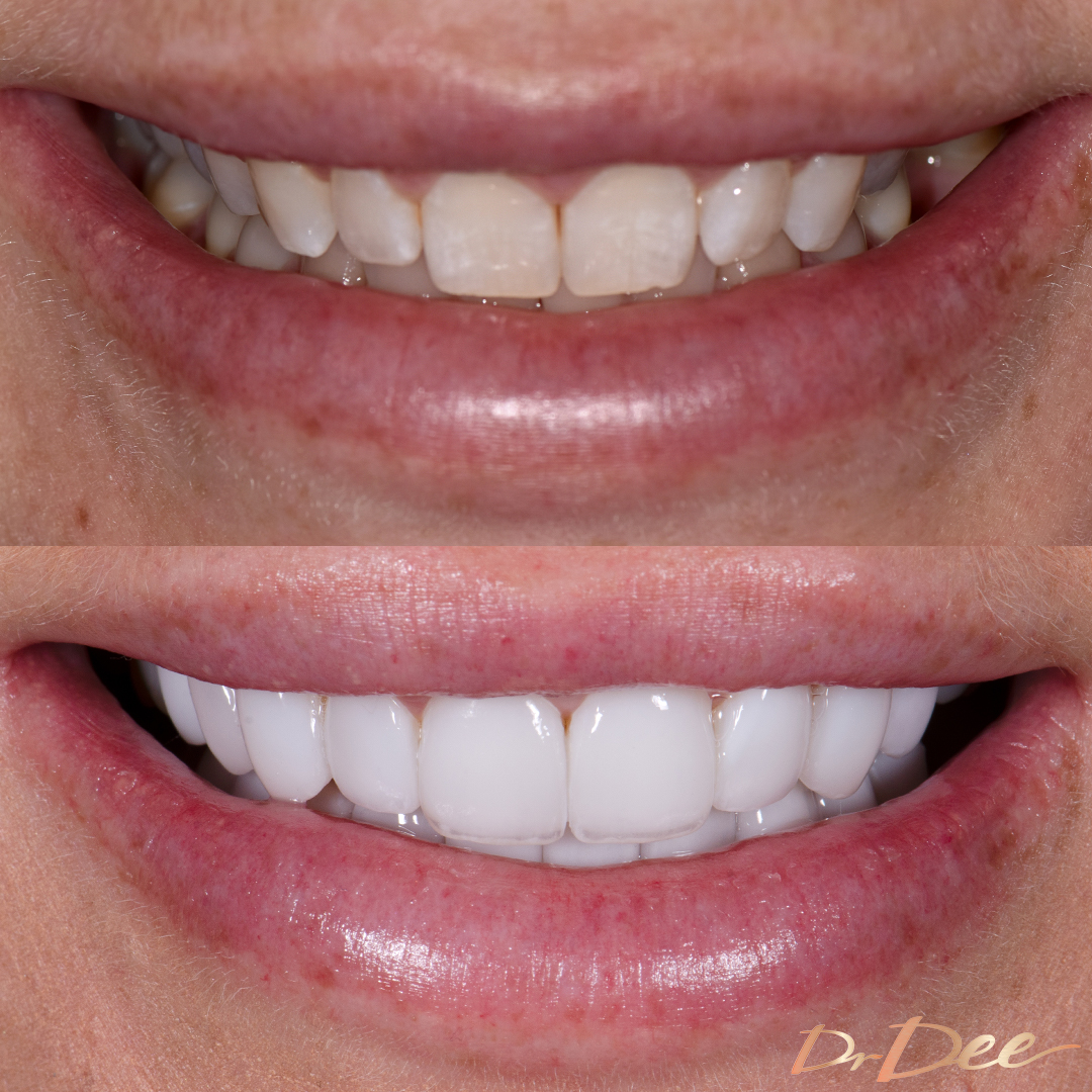 Melissa Rawson before and after Picasso Porcelain Veneers front teeth view.