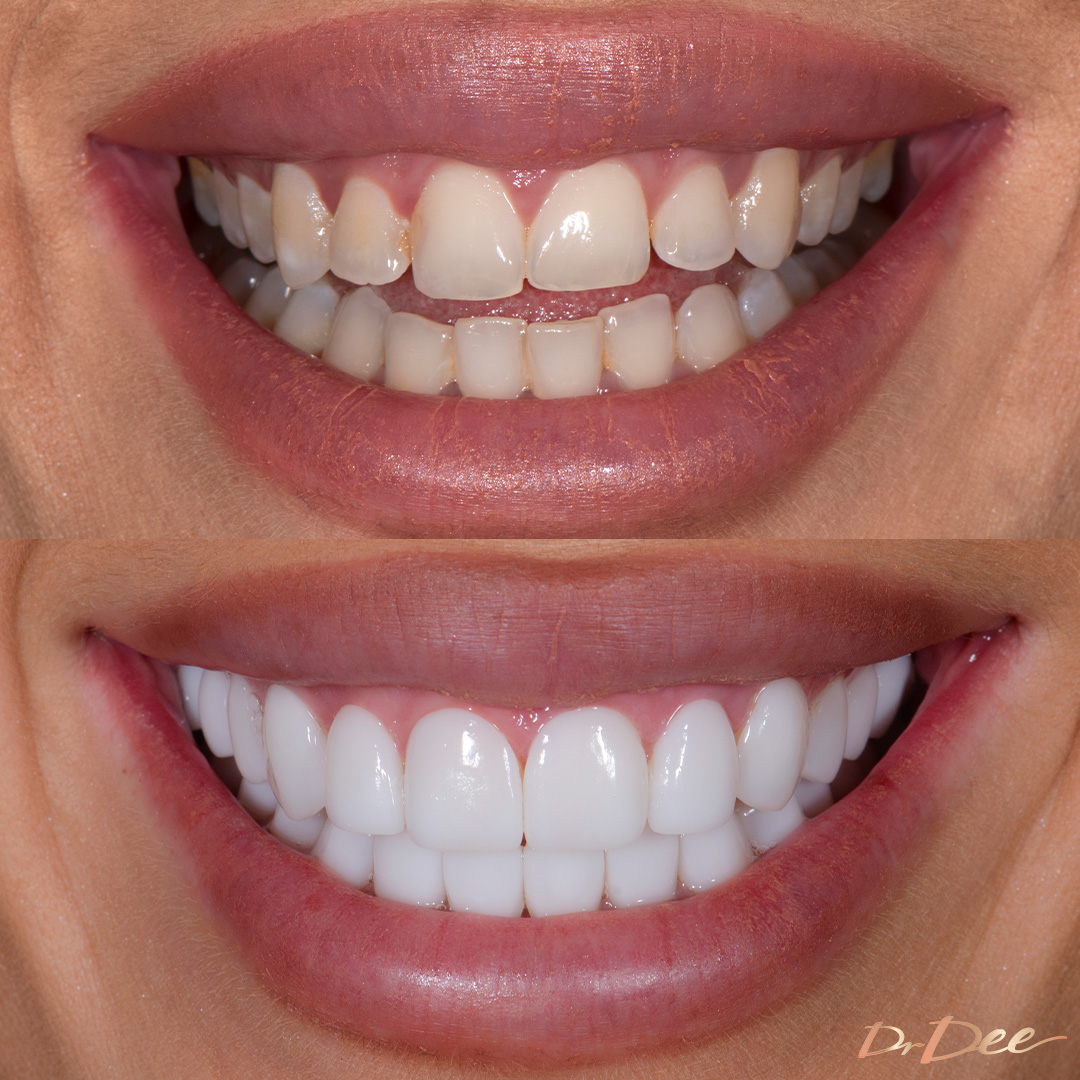 Before and after porcelain veneers smile makeover at Vogue Dental Studios - front teeth view Selin