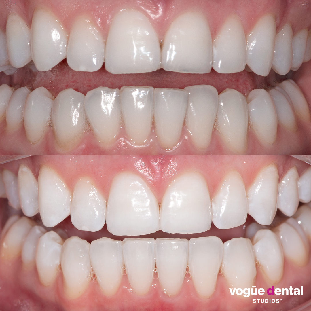 Before and after Invisalign Express at Vogue Dental Studios - front retracted view. Sarah