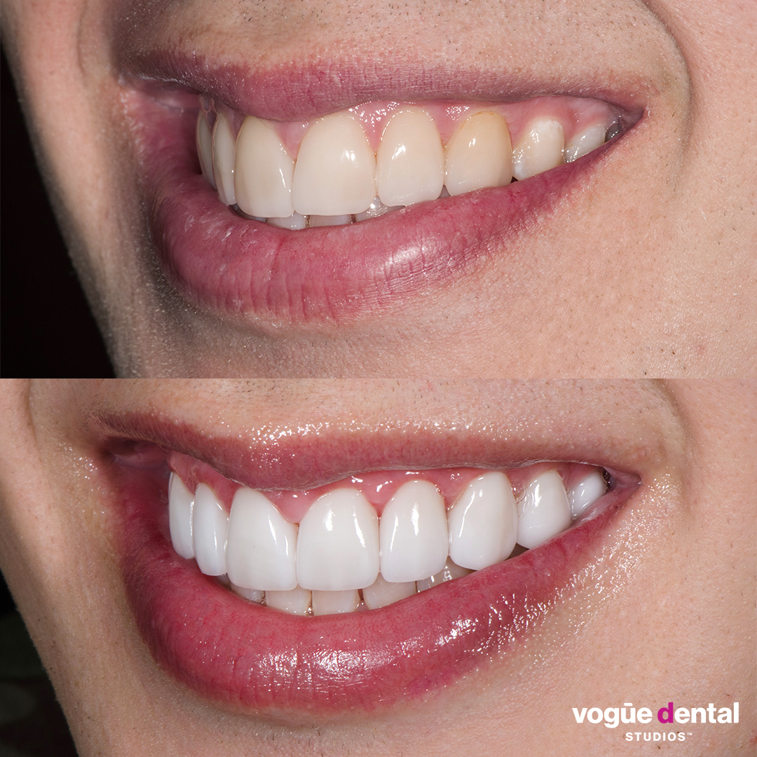 Liam Ferrari before and after porcelain veneers by Dr Dee.