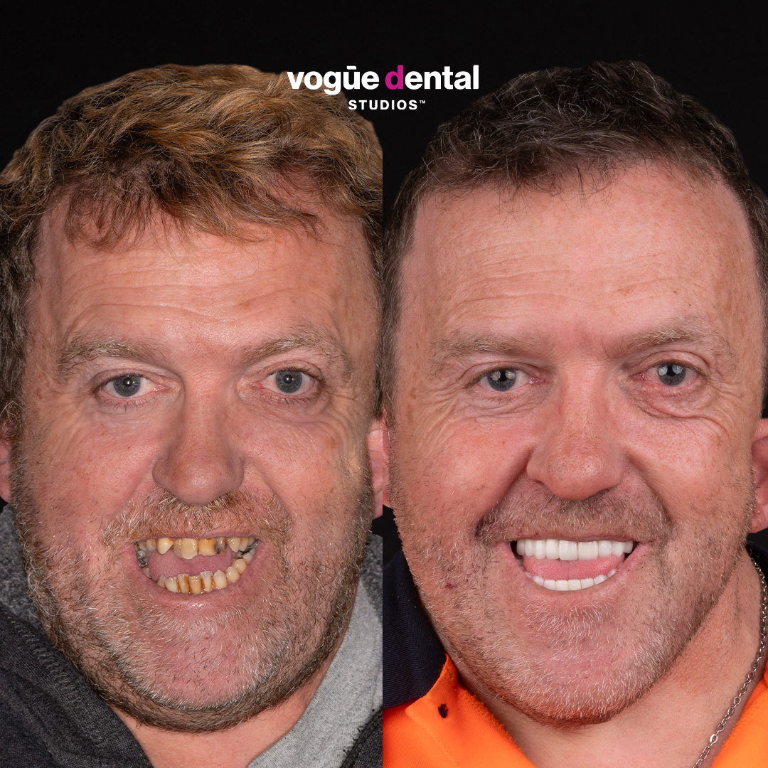 Before and after uneven and broken teeth with porcelain veneers at Vogue Dental Studios - front teeth view Lee.