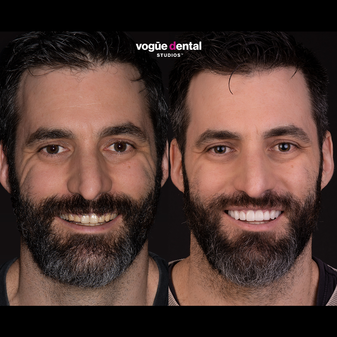 Before and after porcelain veneers Anthony rounded shapes - front face