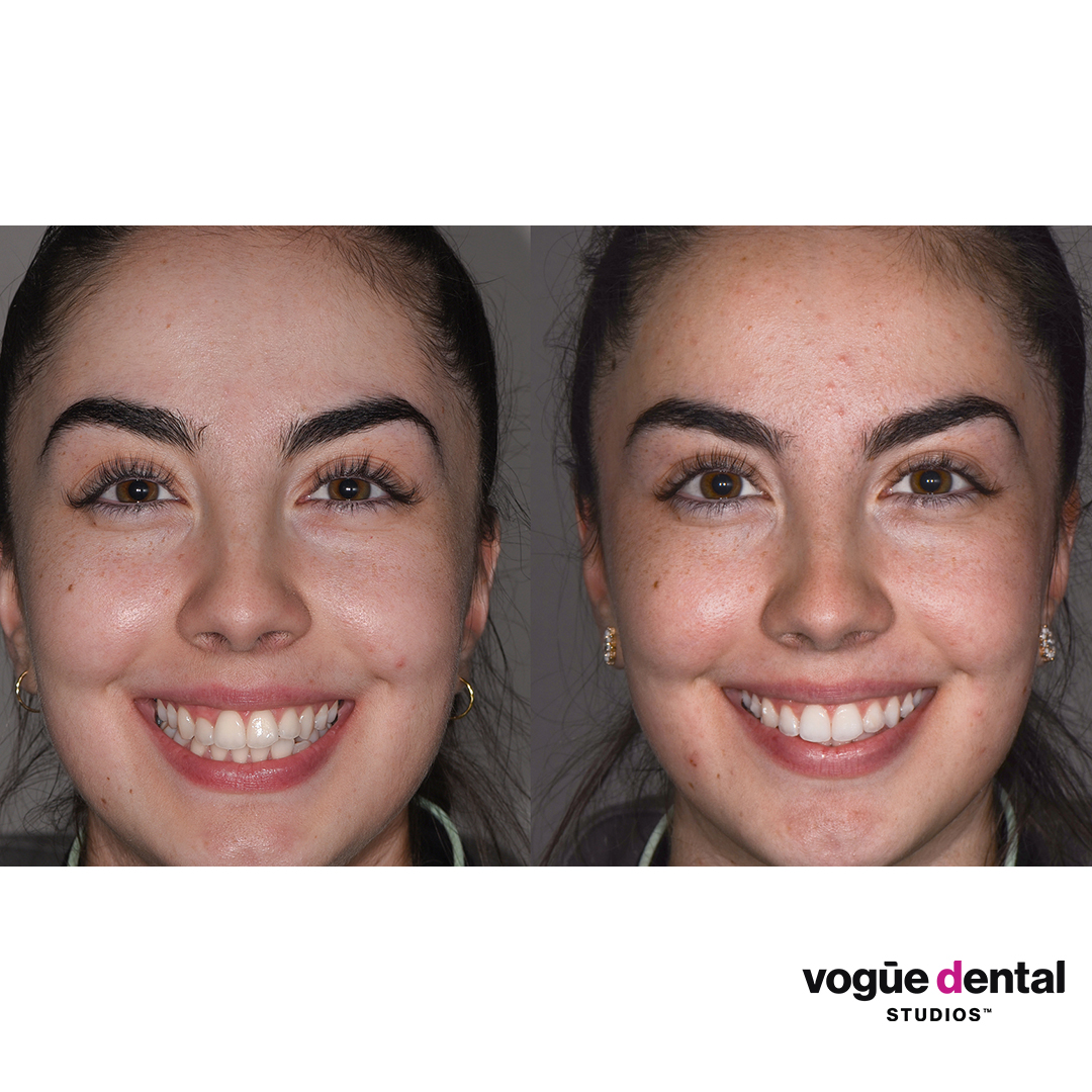 Emily Invisalign and whitening at Vogue Dental Studios - Face smiling view 