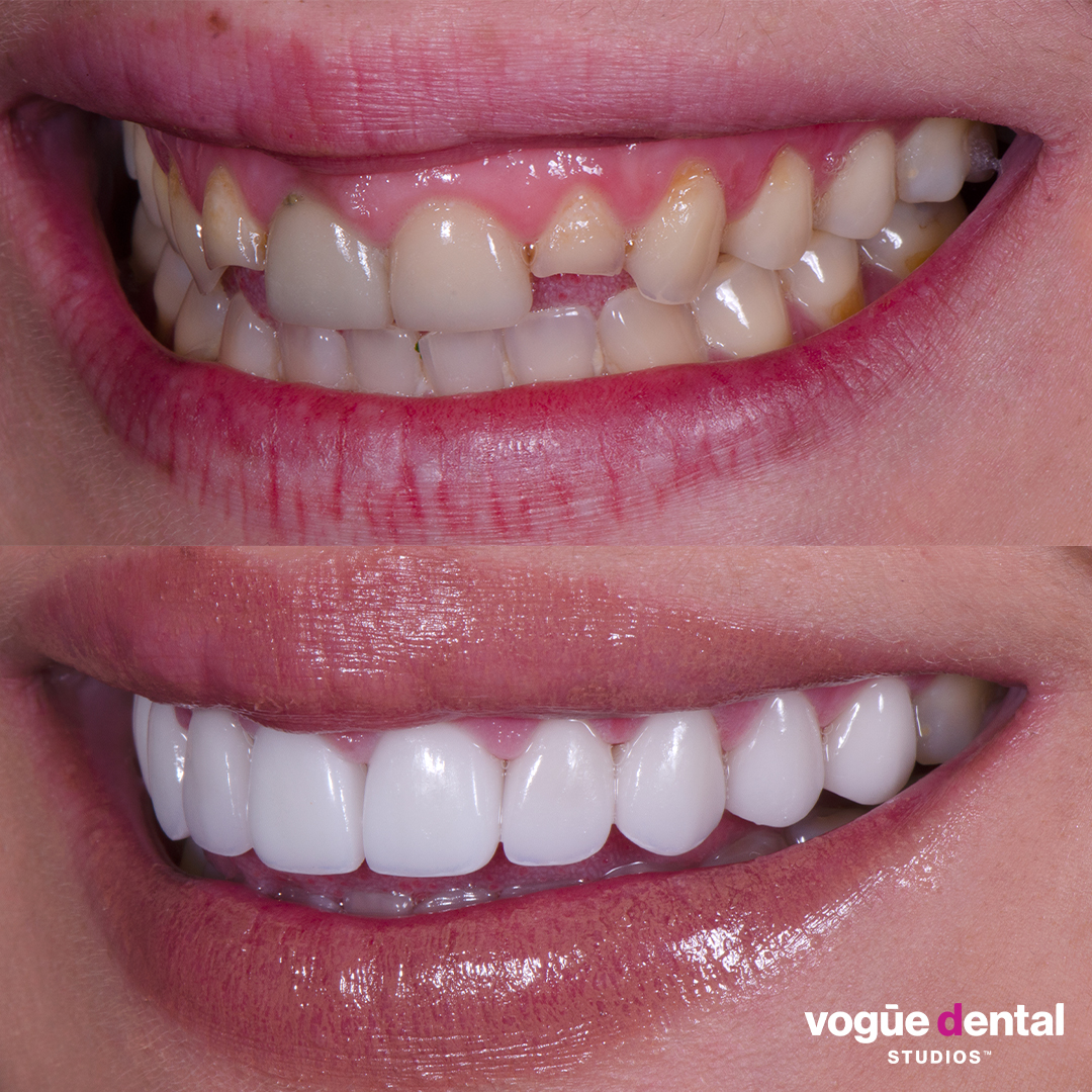 Before and after small teeth with porcelain veneers at Vogue Dental Studios - left teeth view Renee.