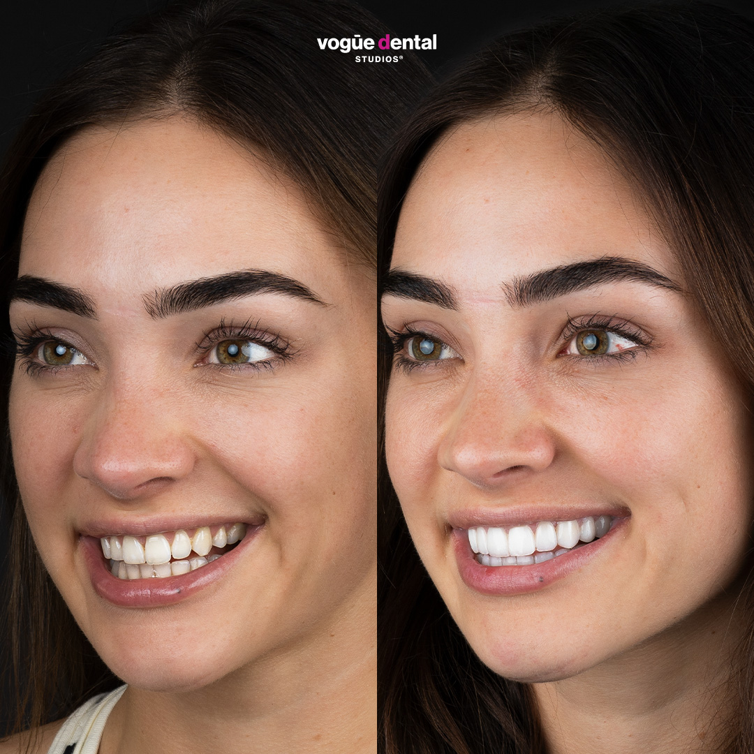 Before and after porcelain veneers at Vogue Dental Studios - left teeth view Monique