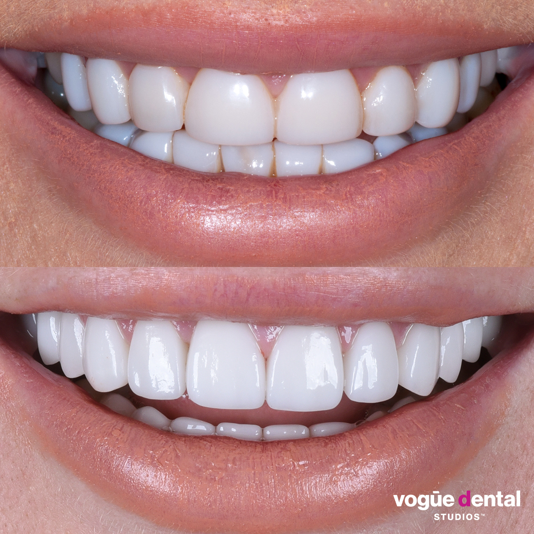Before and after old composites with porcelain veneers at Vogue Dental Studios - front teeth view Keira Maguire.