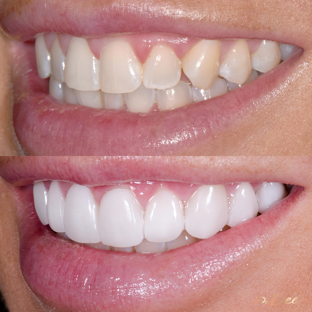 Before and after porcelain veneers at Vogue Dental Studios - left smile view Krystell