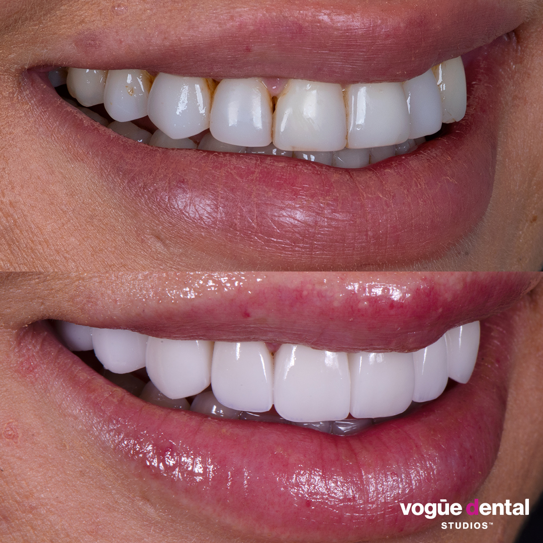 Before and after porcelain veneers at Vogue Dental Studios - Right Side View Jessica Brody The Bachelor