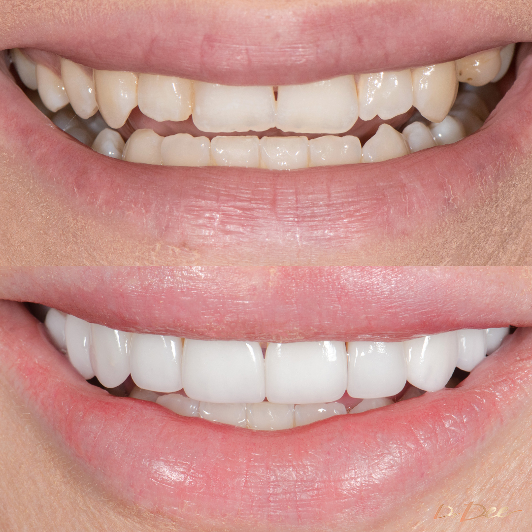 Before and after veneers missing teeth dental pain