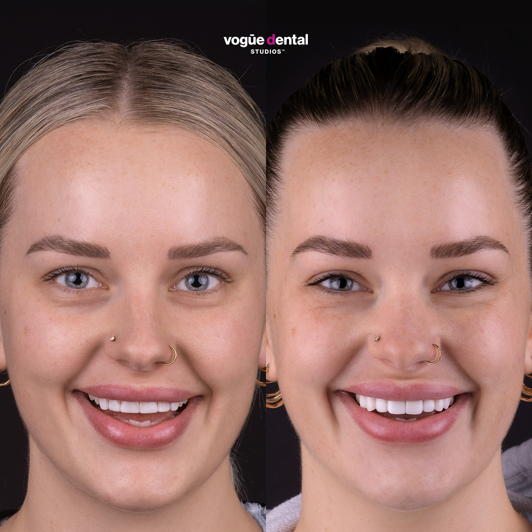 Picasso Porcelain Veneers Before And After Heidi Vogue Dental Studios