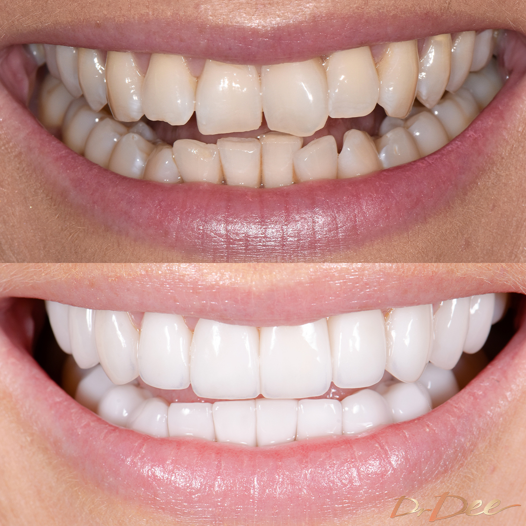 Joanne Todd's teeth before and after porcelain veneers by Dr Dee - front teeth view. 