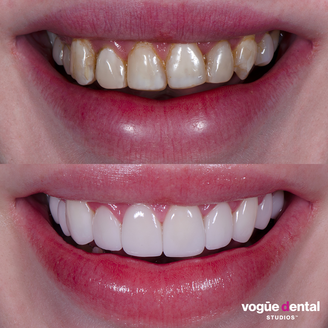 Before and after old composite veneers with porcelain veneers at Vogue Dental Studios - front teeth view Jack.
